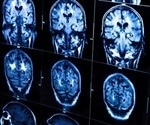 Fibromyalgia causes structural brain changes