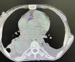 Treatment and Prognosis of Mediastinitis