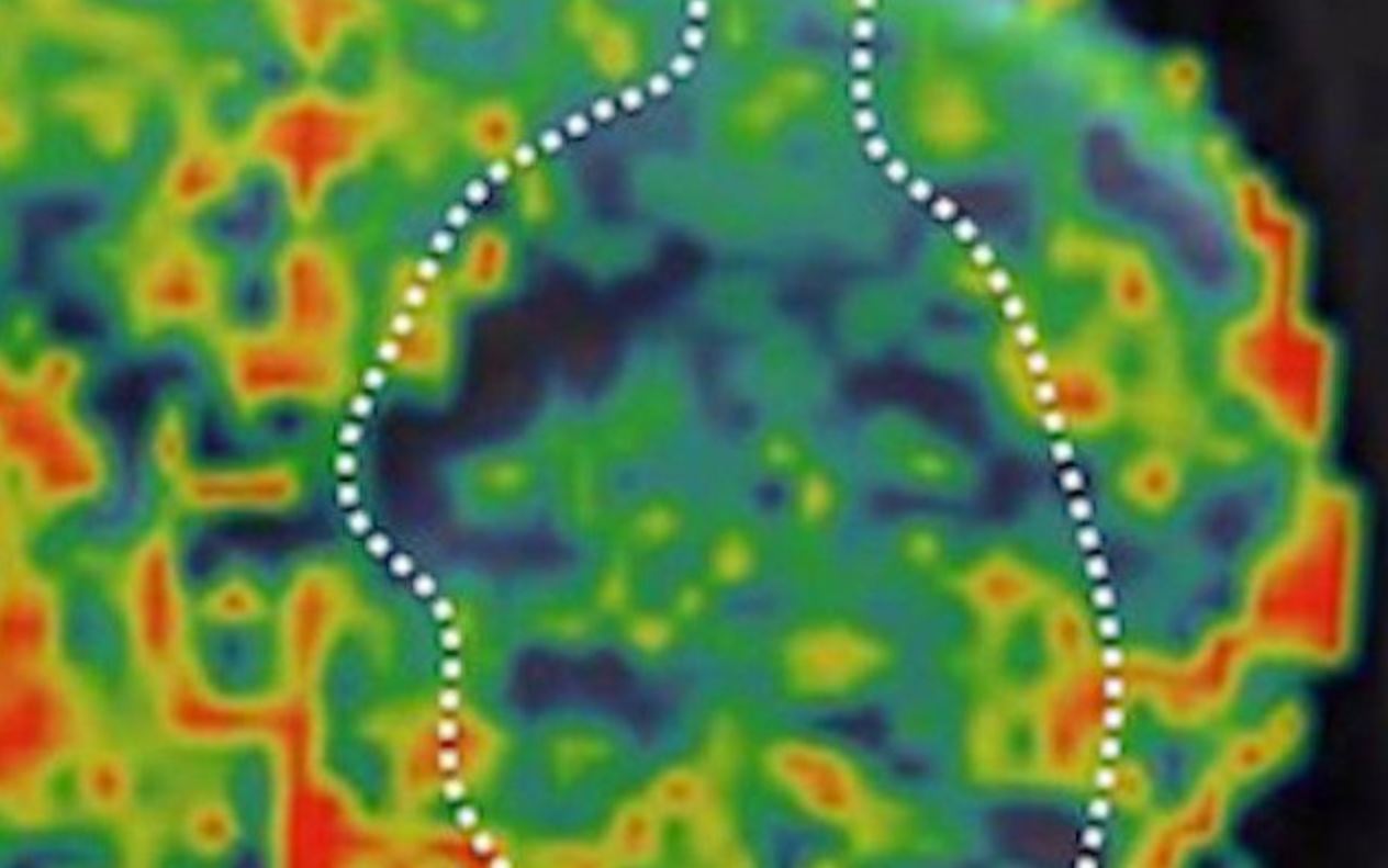 Metabolic Imaging in Neurodegenerative Disease using CEST MRI